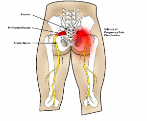 pregnancy and sciatic pain