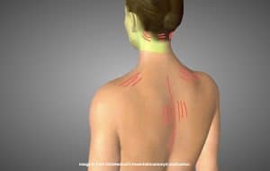 Key muscles causing Neck pain